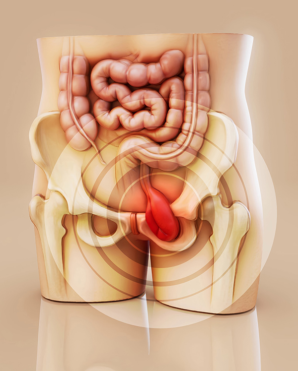 hernia
