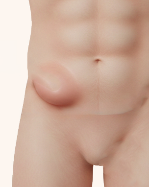 hernia